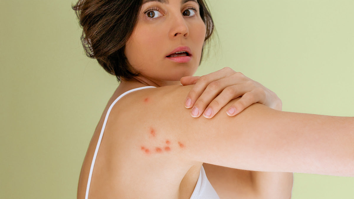 What Are the Symptoms of Flea Bites on Humans and How to Get Rid of Fleas?